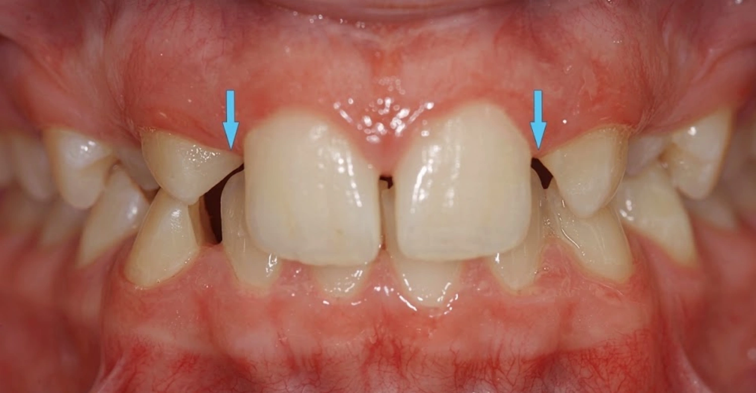 Hypodontia 2